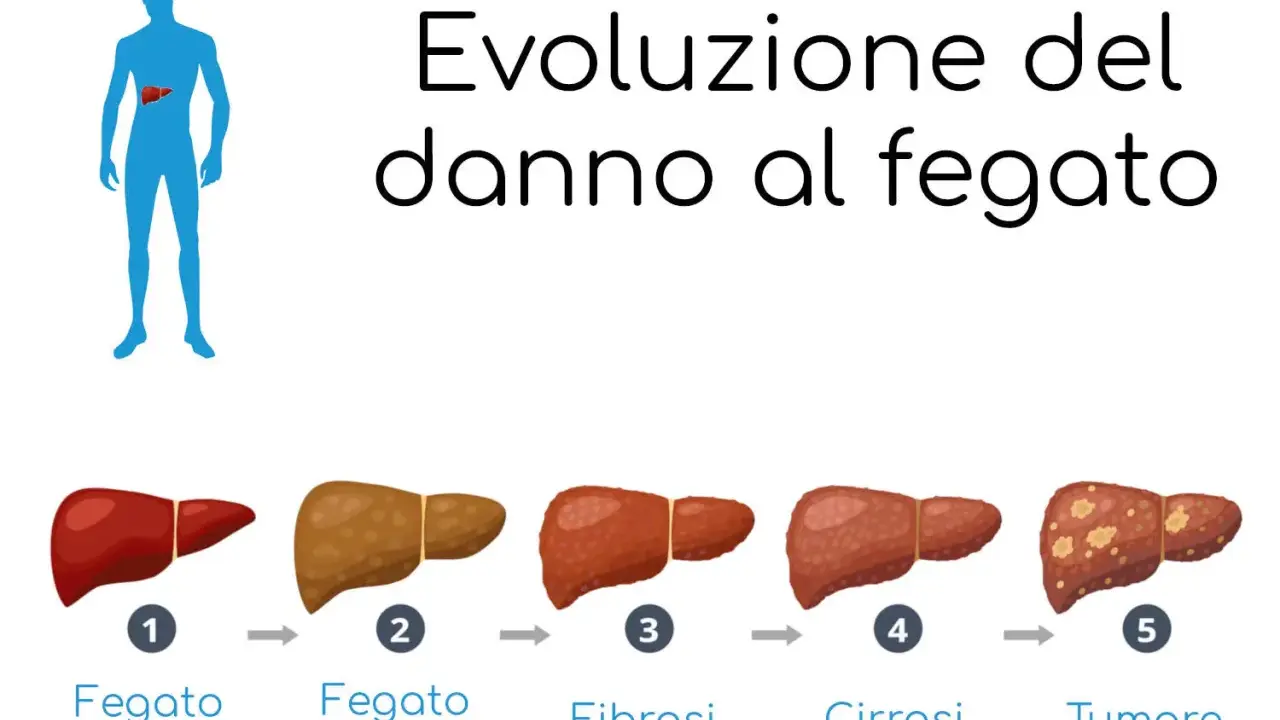 Illustrazione mostra l'evoluzione del danno al fegato: da sano a grasso, fibrosi, cirrosi e tumore.