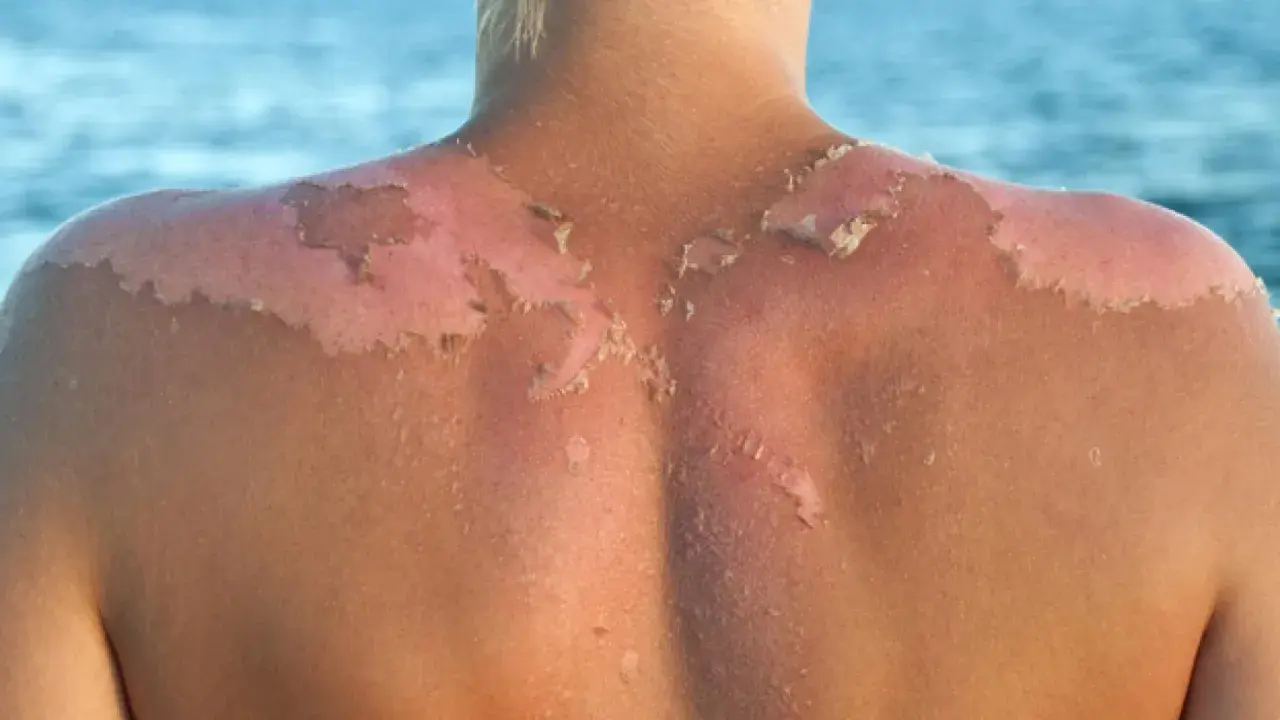 Piel descascarada por quemadura solar. Descubre cómo detener el peeling tras la insolación y aliviar tu piel.