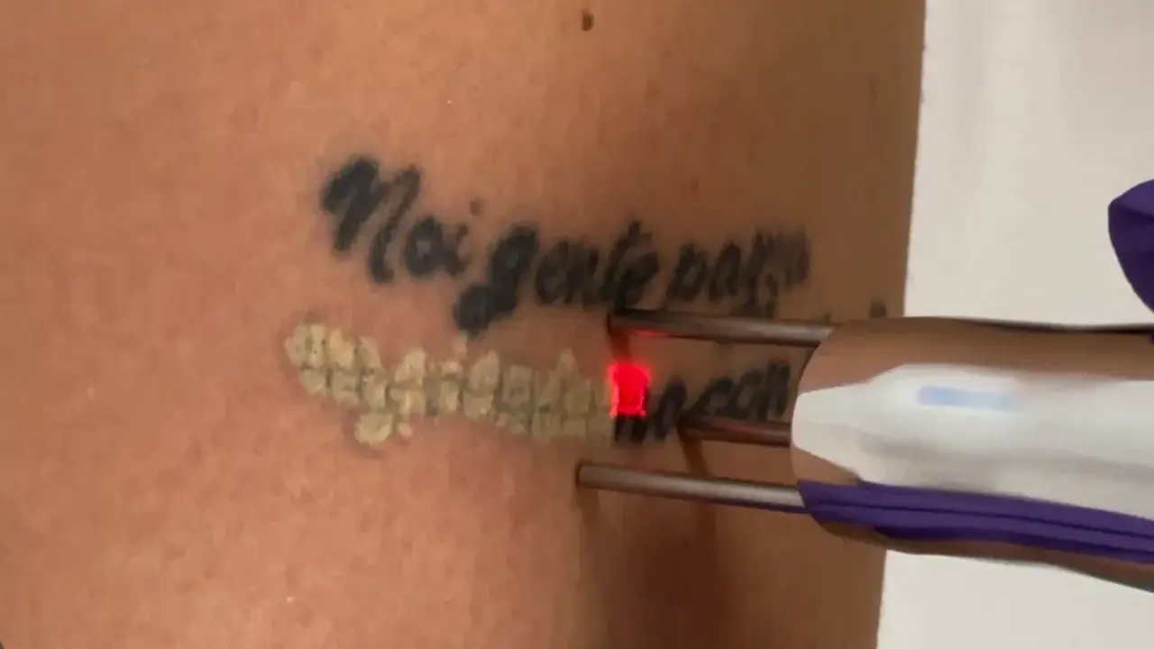 Rimozione tatuaggio con laser: un fascio rosso illumina la pelle mentre si procede a togliere il disegno.