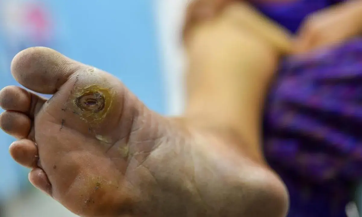 Pied diabétique grade 3 avec une plaie ouverte sur la plante du pied, nécessitant des soins médicaux urgents.