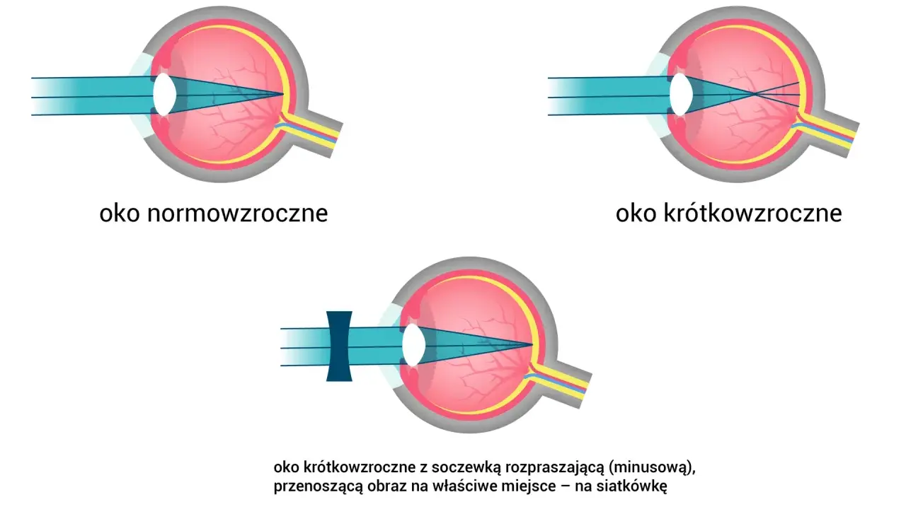 Ilustracja oka: normowzroczne, krótkowzroczne i krótkowzroczne z soczewką korygującą.