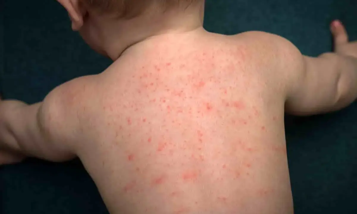Schiena di neonato con eruzione cutanea rossa diffusa, forse dovuta a sudorina sulla pelle.