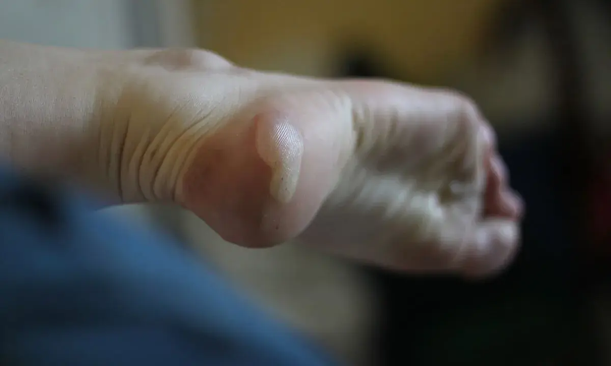 Gros plan sur un pied avec une phlyctène sur le talon, nécessitant un traitement.