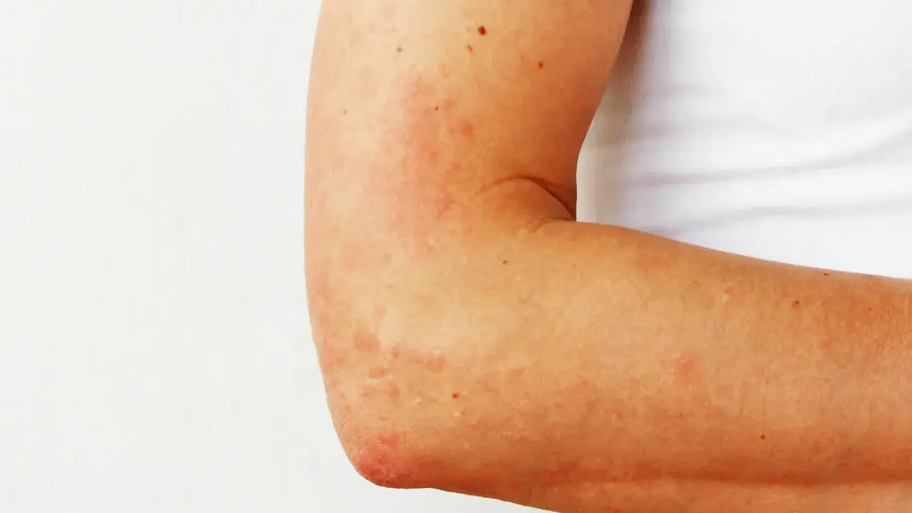 Plaques rouges et irritées sur le coude, signe d'eczéma.