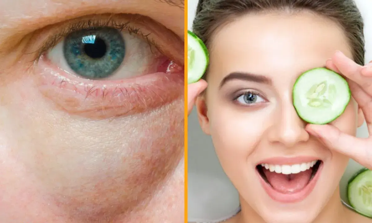 Ojo con bolsas y ojeras, y una mujer sonriente con rodajas de pepino, mostrando remedios caseros para las bolsas en los ojos.