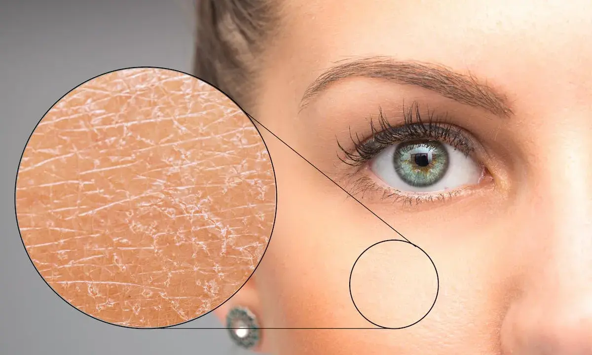Gros plan sur un œil et une partie du visage d'une femme, avec un zoom montrant la **peau sèche du visage** craquelée et une autre zone plus lisse.