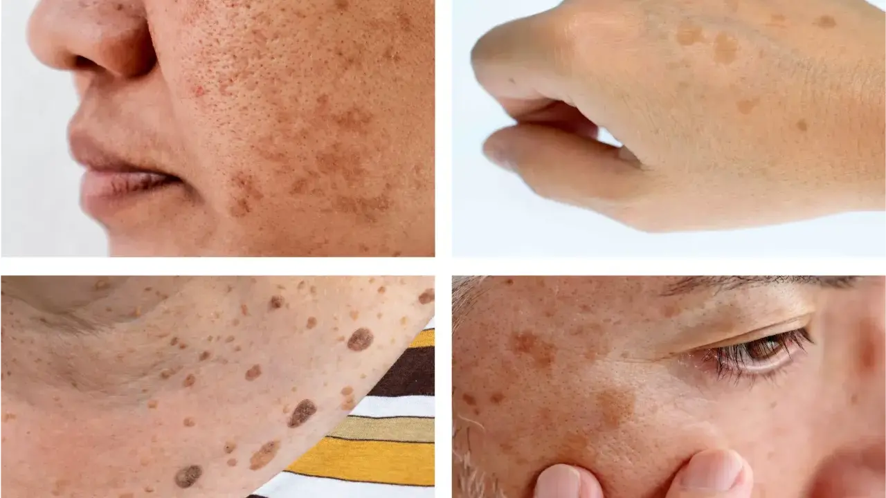 Gros plan sur des taches brunes sur la peau, dont un lentigo solaire sur le visage et le dos de la main.