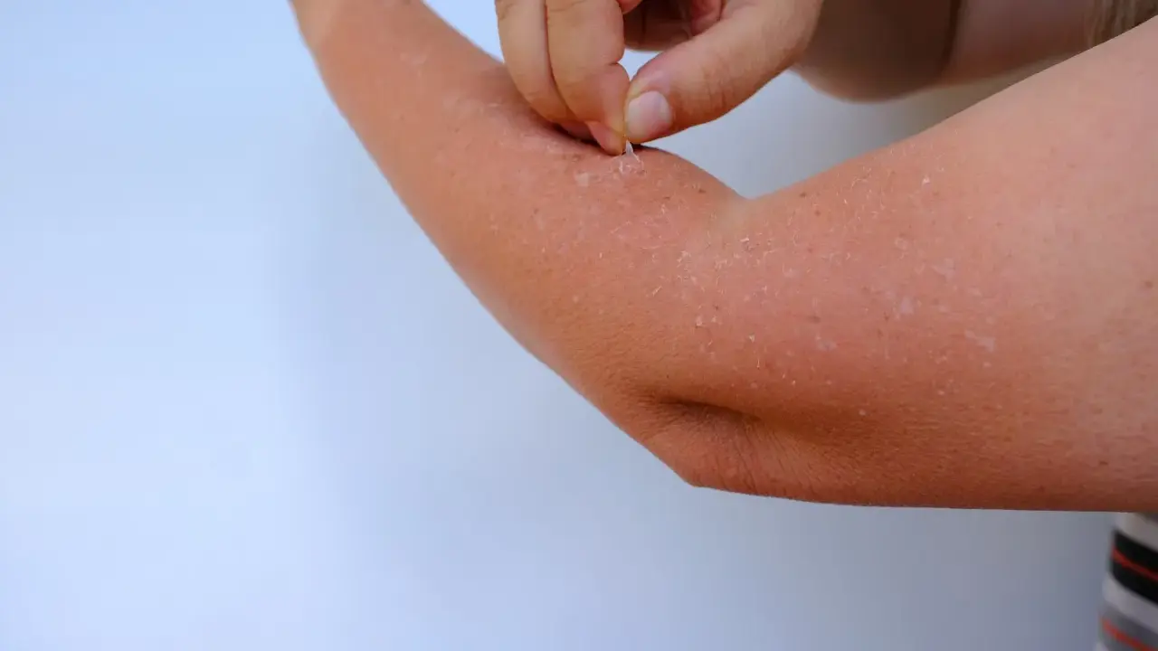 Main d'une personne qui retire des lambeaux de peau qui pèle sur son bras, signe d'un coup de soleil.