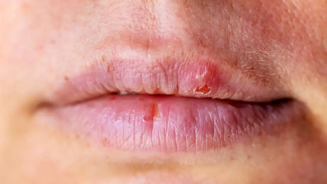 Labbra secche e screpolate, con piccole lesioni. Potrebbe essere un segnale che il fegato ha bisogno di attenzione.