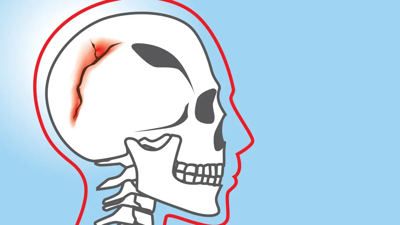 Ilustracja czaszki z widocznym pęknięciem i zaczerwienieniem, wskazującym na wgłębienie w czaszce.