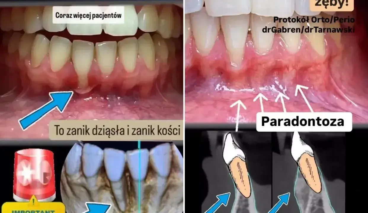Zaniedbane dziąsła i kość to paradontoza. Leczenie recesji dziąseł i odbudowa kości to klucz do ratowania zębów.