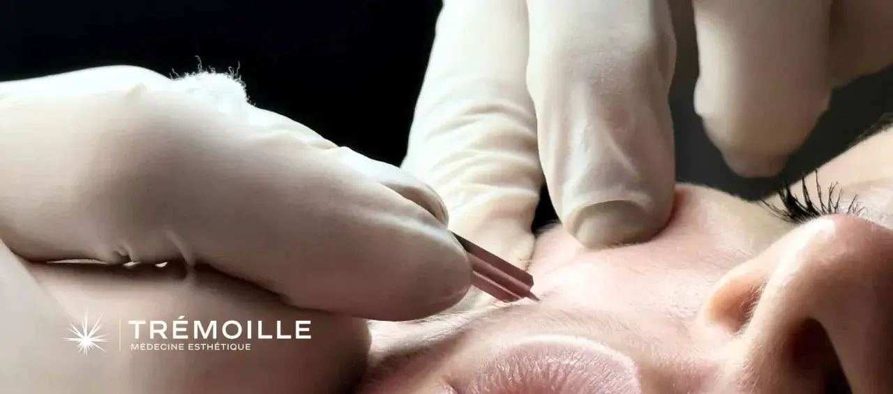 Gants blancs et outil fin pour l'extraction de gros points noirs sur le nez. Soin esthétique précis.