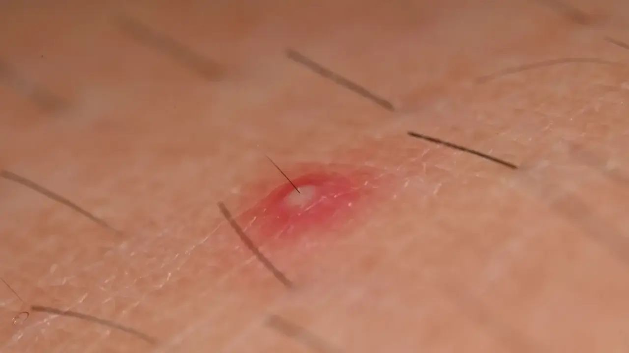 Widoczny czerwony pryszcz z białym czubkiem i włoskiem, objaw zapalenia mieszka włosowego.