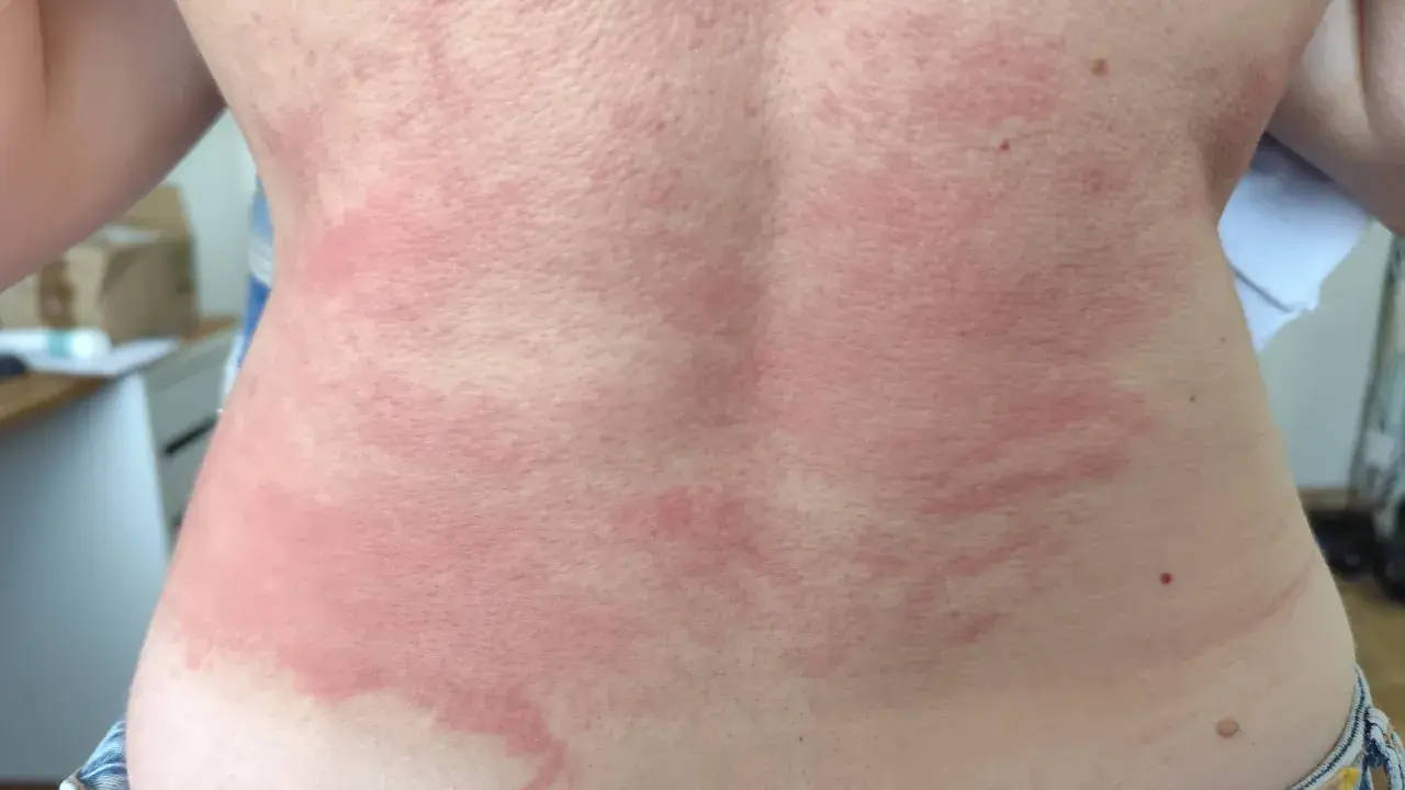 Le dos présente des rougeurs et des plaques, signe d'une réaction cutanée. Il est urgent de trouver une solution pour calmer les démangeaisons.