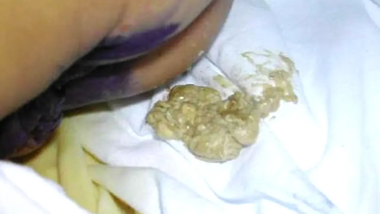 Feci grasse e giallastre, indicative di steatorrea, su un pannolino. Le cause possono essere molteplici.
