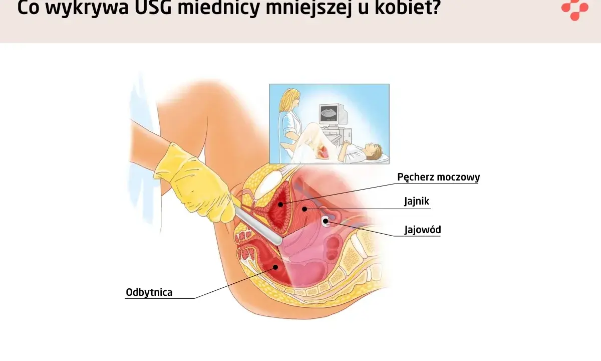 Ilustracja pokazuje, jak wygląda macica podczas badania USG. Widoczne są pęcherz moczowy, jajnik, jajowód i odbytnica.