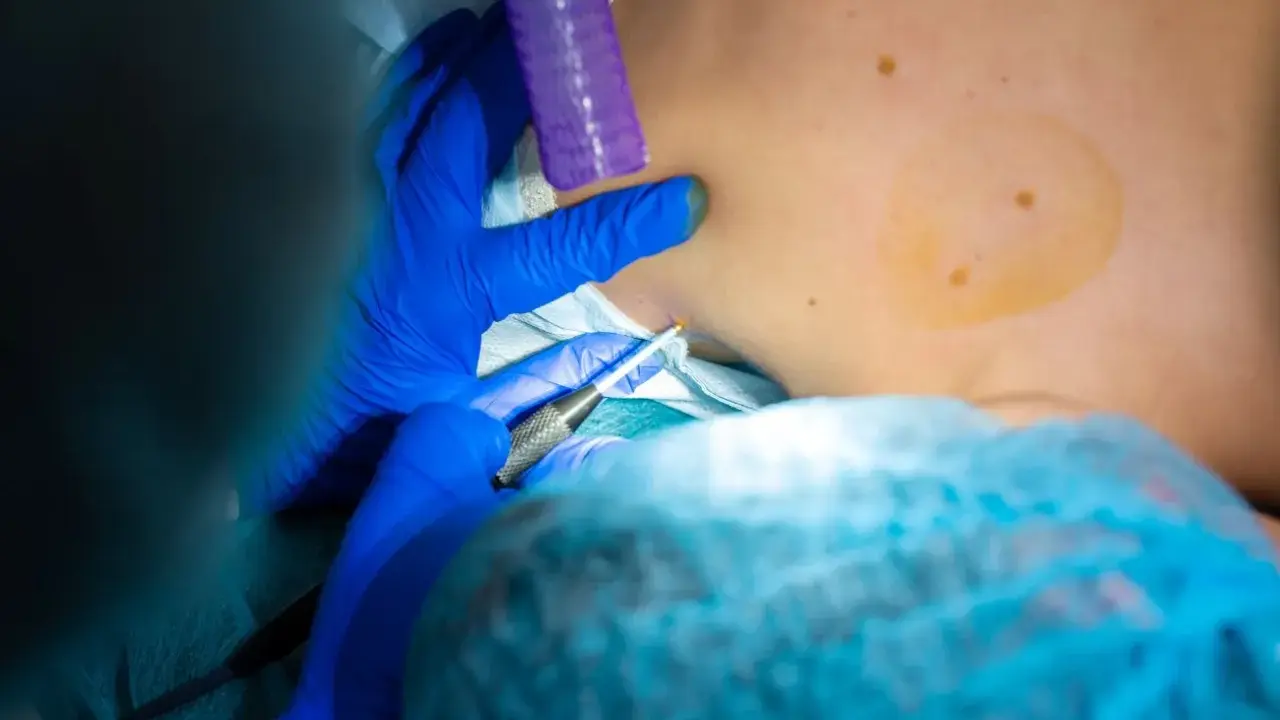Lekarz pobiera próbkę tkanki. Czy biopsja oznacza raka? Nie zawsze, to ważny krok diagnostyczny.