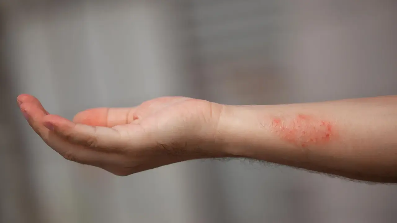 Poignet présentant une dartre cutanée rouge et irritée.