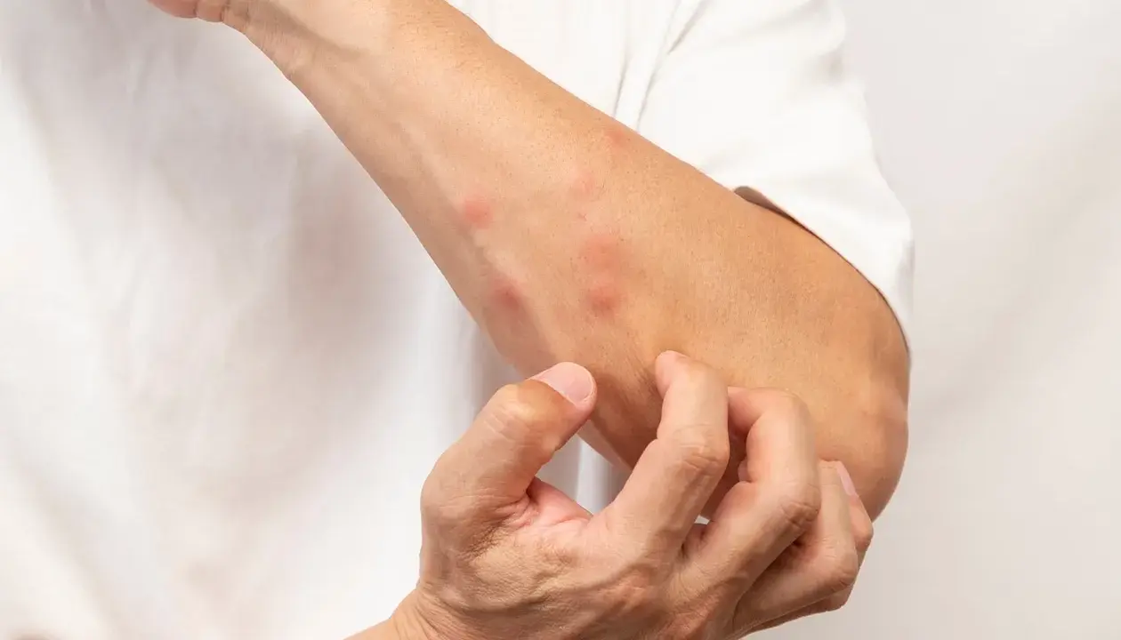 Un bras couvert de boutons rouges, la personne se gratte pour savoir comment ne pas se gratter les boutons de moustiques.