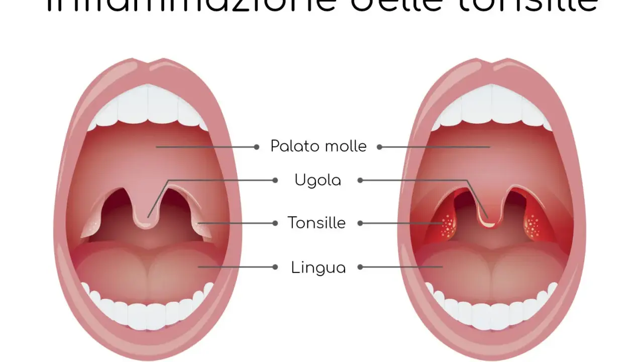 Illustrazione che mostra un'infiammazione delle tonsille, comune nel mal di gola dei bambini. Le tonsille gonfie e rosse sono visibili.