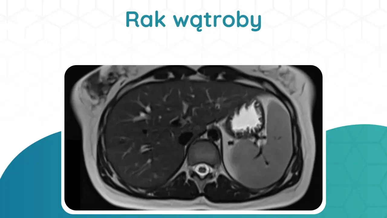 Przekrój tomografii komputerowej wątroby z widocznym guzem.