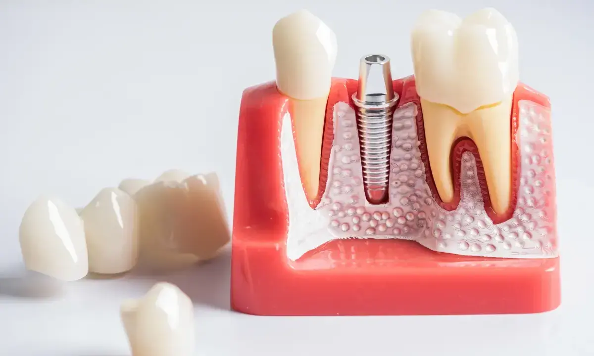 Ból po wyrwaniu ósemki: Ile trwa, co jest normą i kiedy do dentysty?