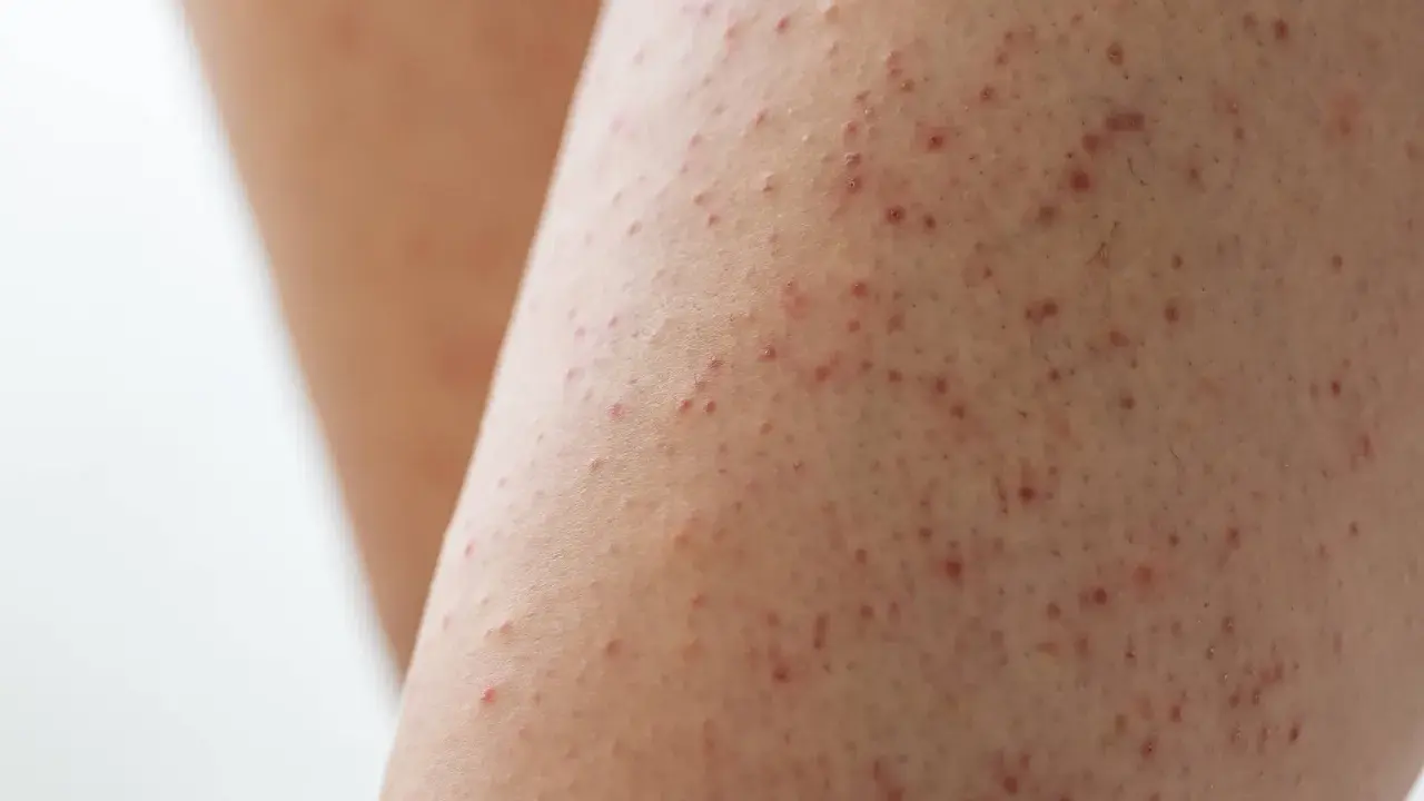 Gros plan sur une peau présentant des petites bosses rouges, typiques de la kératose pilaire.