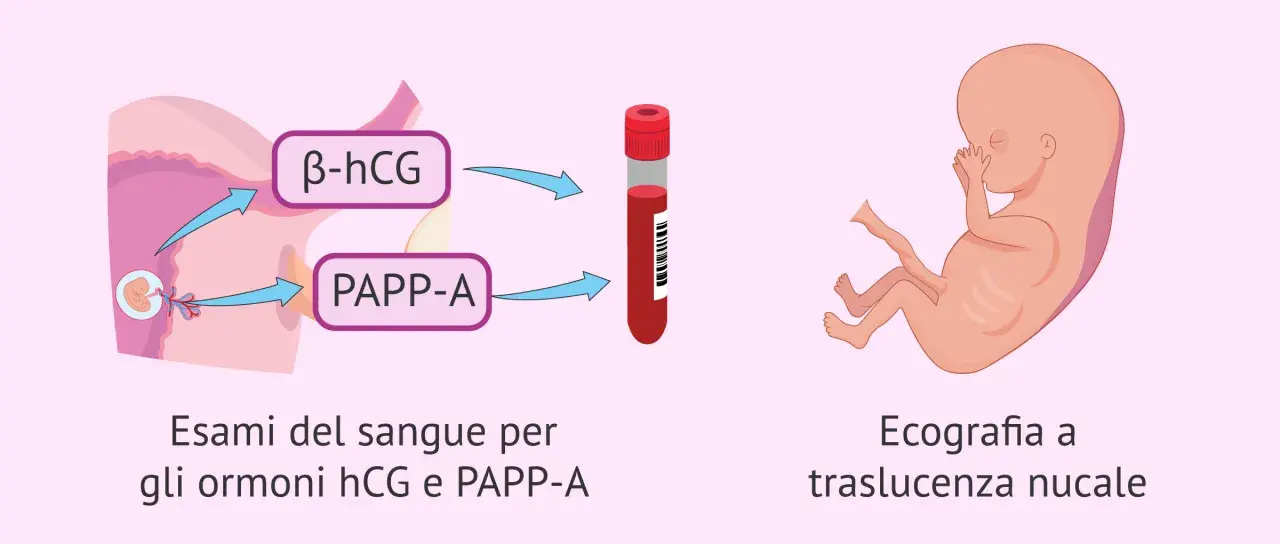 Esami del sangue per ormoni hCG e PAPP-A, ecografia a traslucenza nucale: il tri test per la salute del feto.