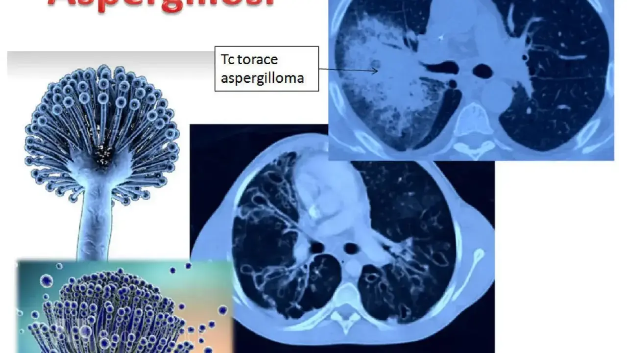 Aspergillosi: immagini di Aspergillus e TAC polmonari che mostrano un aspergilloma. L'aspergillosi è contagiosa.