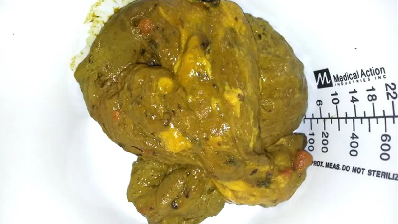 Feci oleose, di colore giallo-verdastro, con residui visibili e una consistenza untuosa. Accanto, una scala graduata.