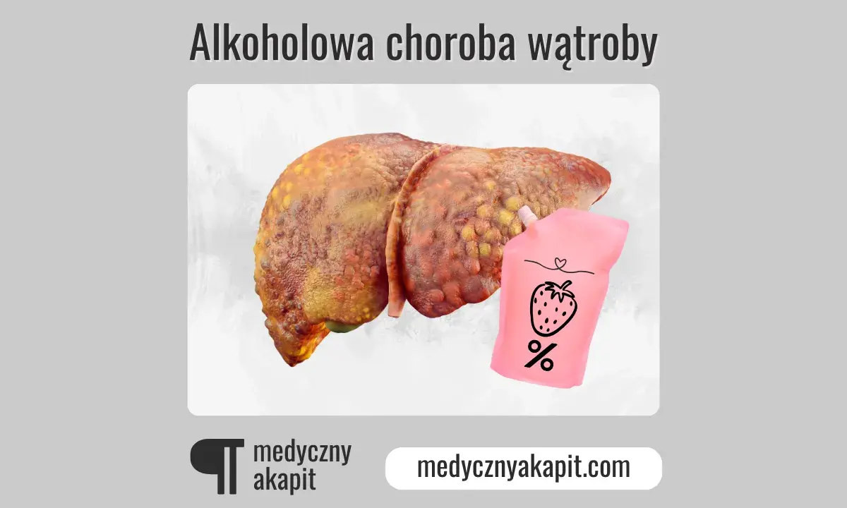 Chora wątroba i woreczek z napisem "%" sugerują, czy alkoholowe zapalenie wątroby jest wyleczalne.