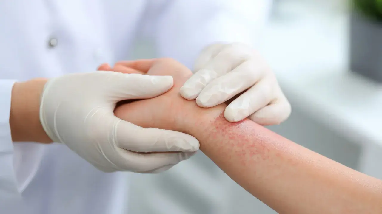 Mains gantées examinant une éruption cutanée rouge sur un poignet, suggérant un traitement eczema.