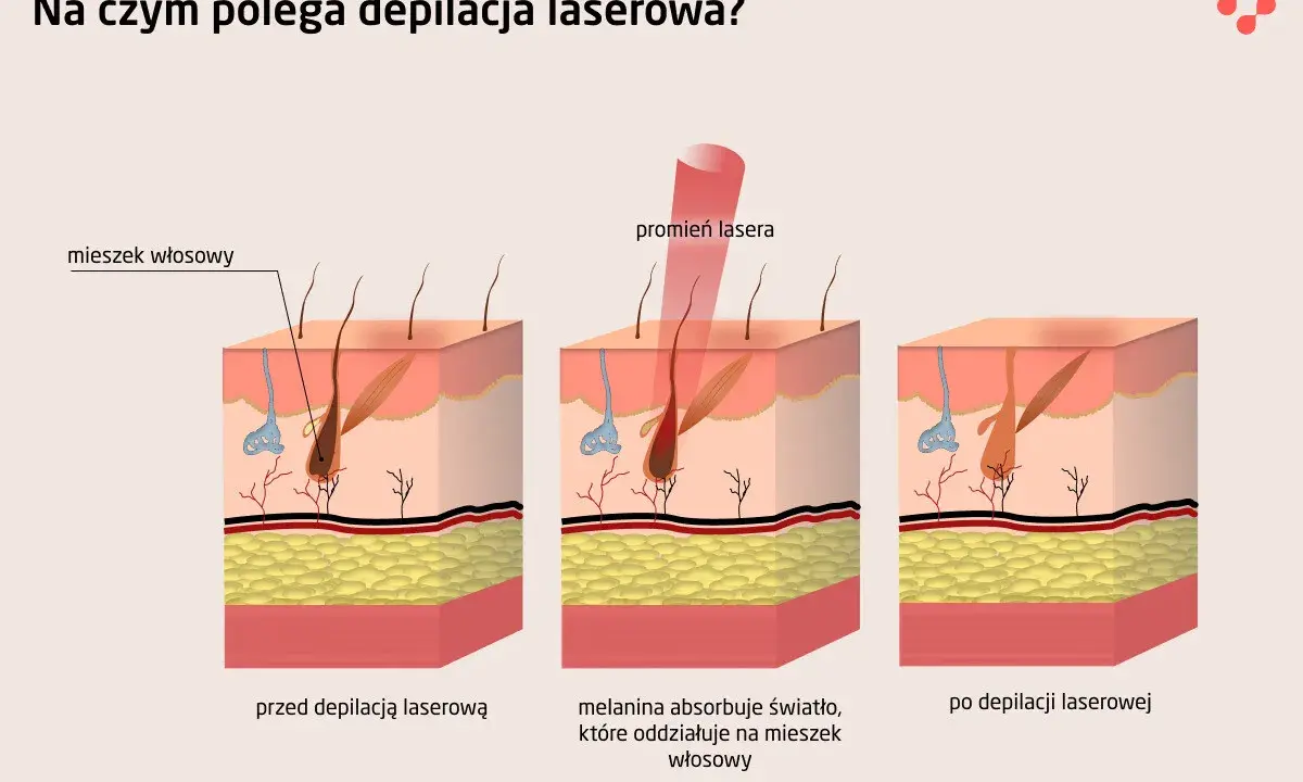 Depilacja laserowa: Golenie przed zabiegiem dlaczego to klucz?
