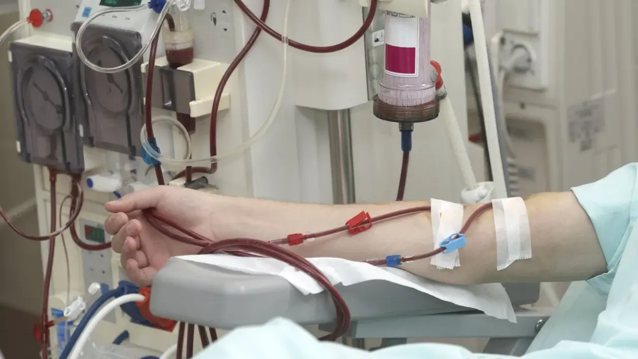Ramię pacjenta podłączone do aparatury do dializy. Częstotliwość dializ jest kluczowa dla jego zdrowia.