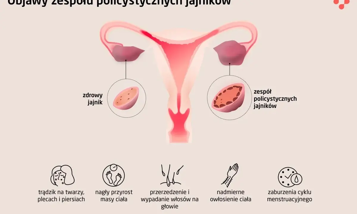 PCOS: Co to jest? Objawy, leczenie i życie z Zespołem Policystycznych Jajników
