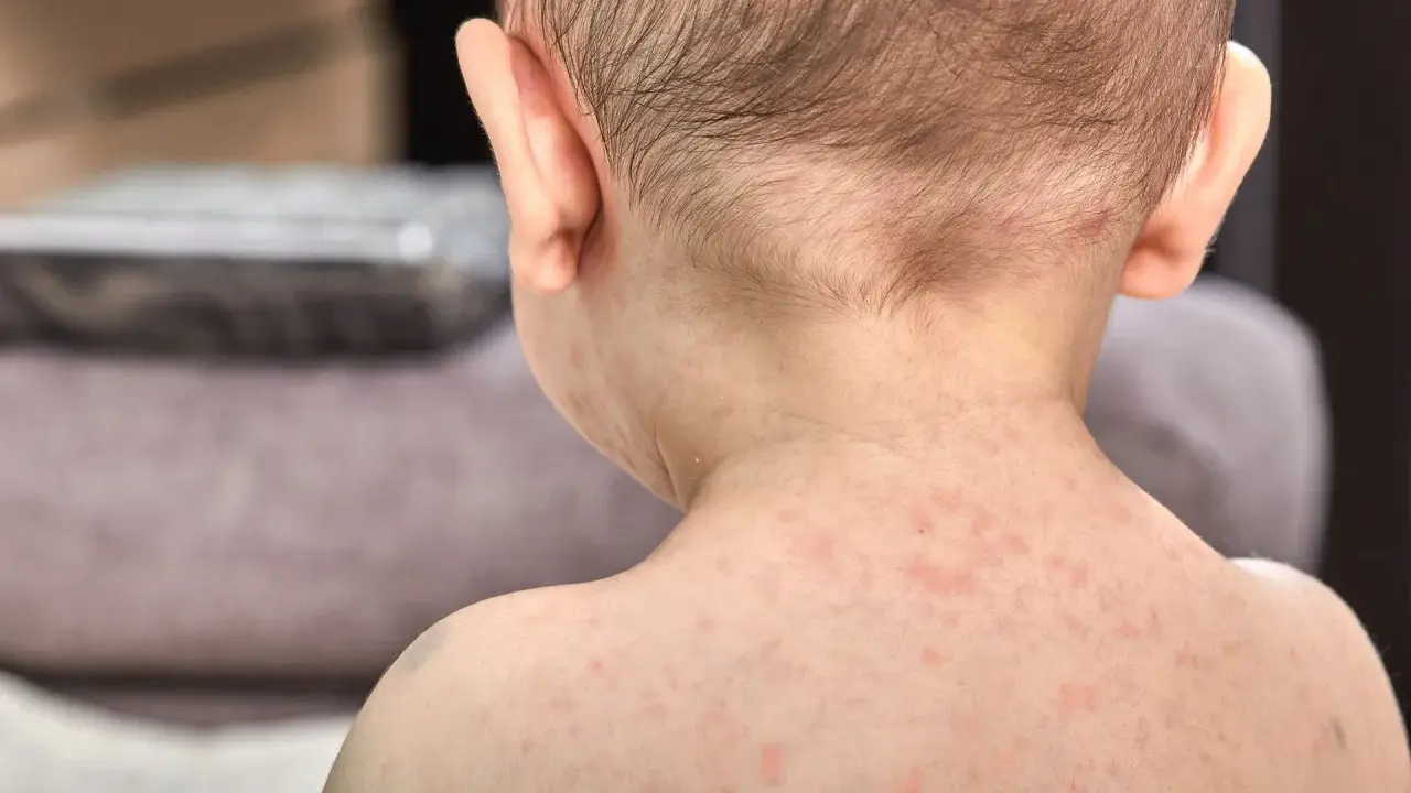 Skóra dziecka pokryta drobnymi, czerwonymi krostkami. To typowa wysypka po trzydniówce, która pojawia się po ustąpieniu gorączki.