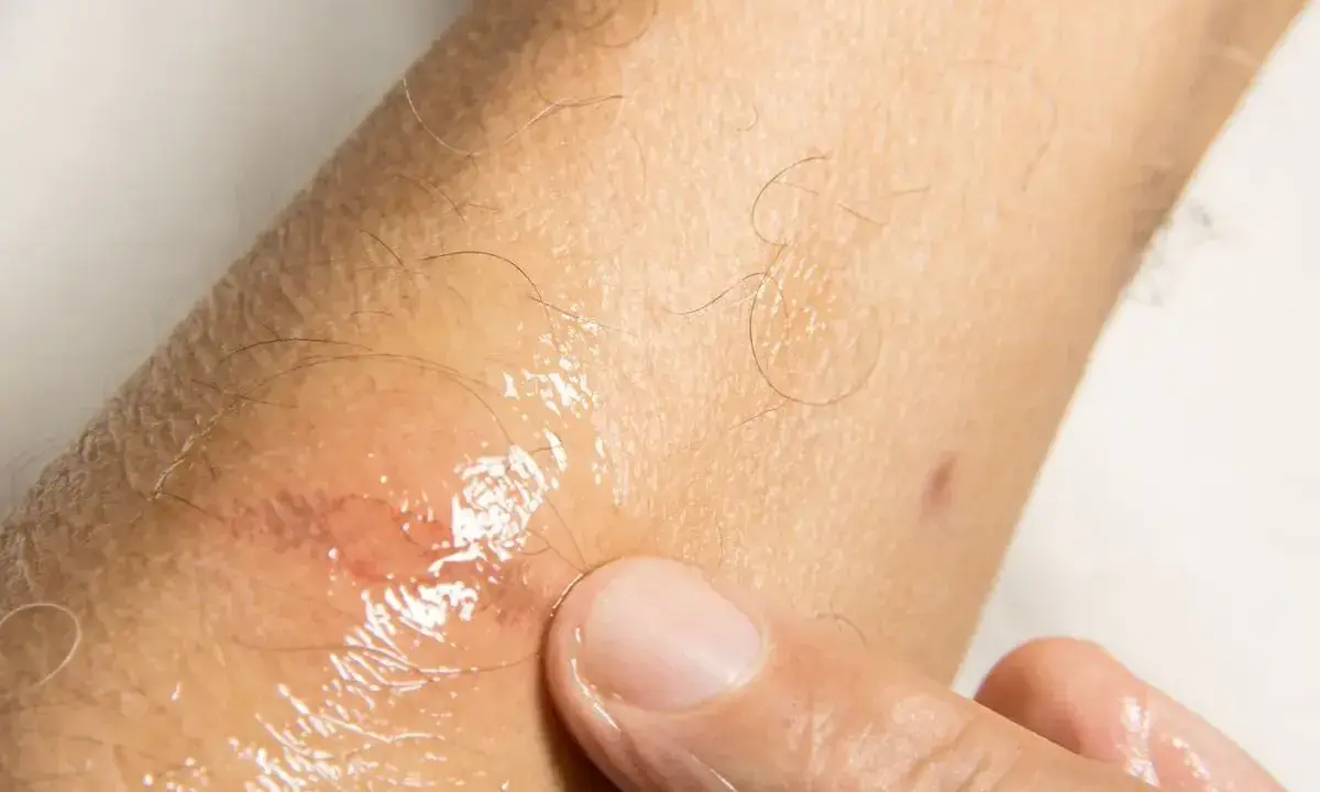 Dito, un dito preme su una lesione cutanea umida e arrossata, forse causata da sudare sempre.
