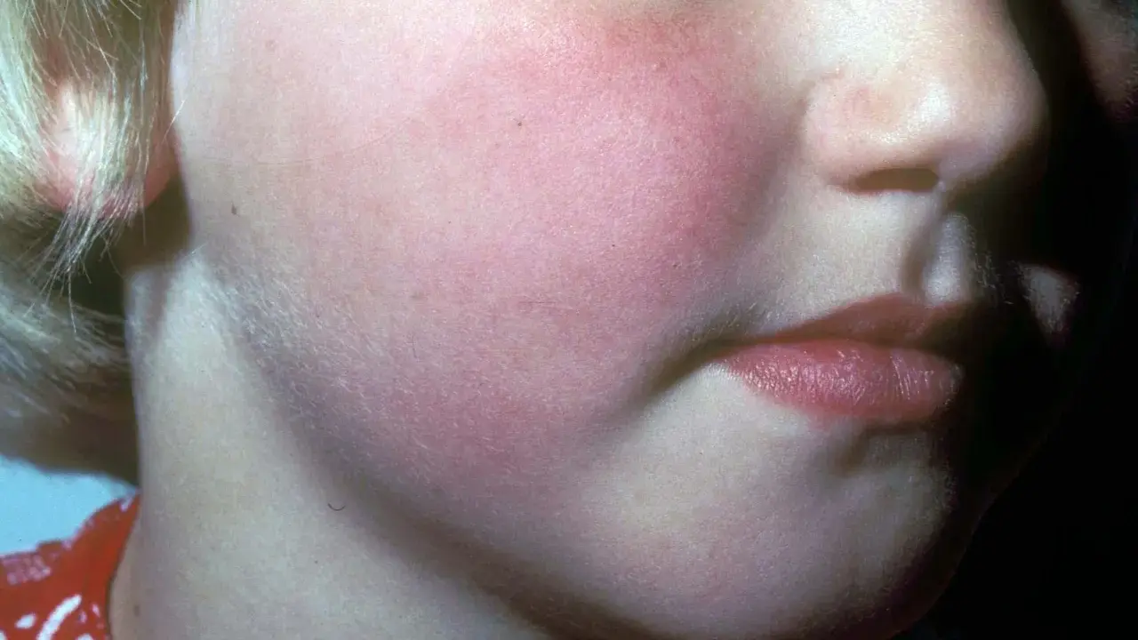 Barnets kinder är röda, vilket kan vara ett tecken på hjärnhinneinflammation. Utslagen är diffusa och rodnande.