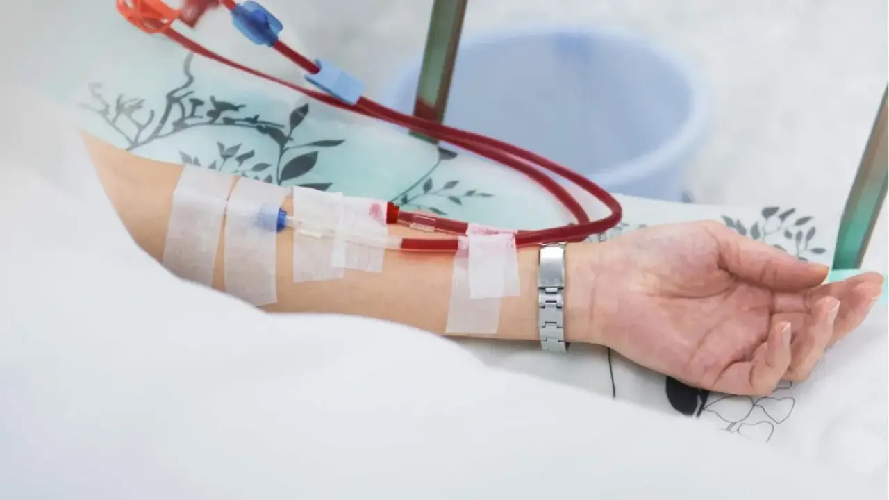Ramię pacjenta z założonym cewnikiem Sheldona, podłączonym do aparatury dializacyjnej.