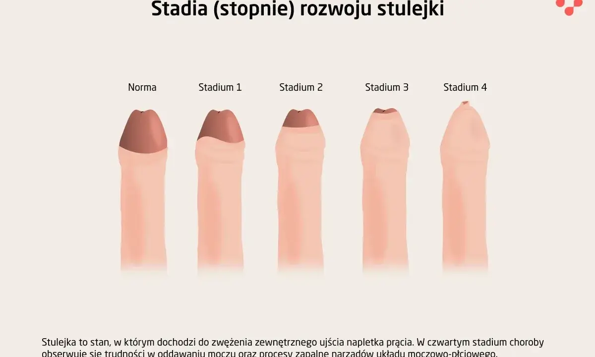Ilustracja pokazuje, jak wygląda penis w różnych stadiach stulejki, od normy do stadium 4.