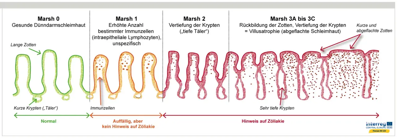 Darstellung der Marsh-Klassifikation von Zöliakie: Von gesunder Schleimhaut (Marsh 0) über Entzündung (Marsh 1-2) bis zur Zottenatrophie (Marsh 3), die bei einer **Haferallergie** auftreten kann.