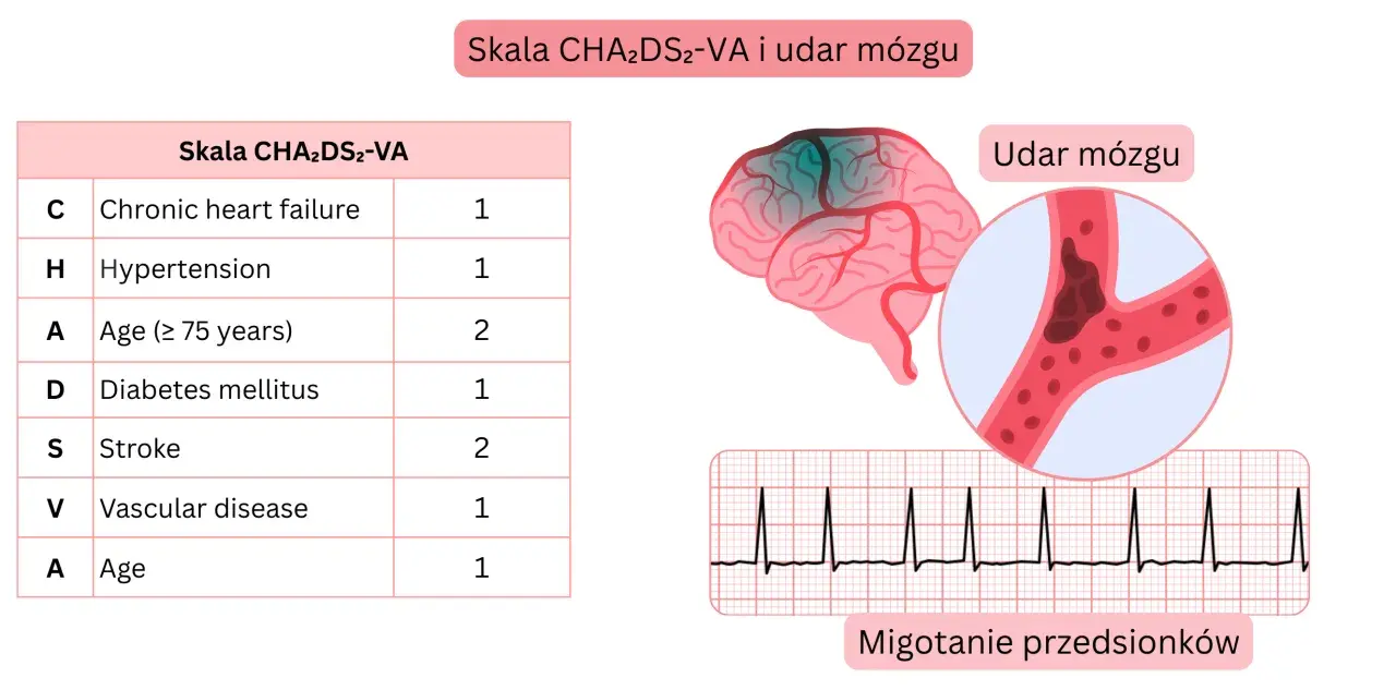 Tabela CHA2DS2-VA, schemat mózgu z udarem, naczynie krwionośne z zakrzepem i EKG.