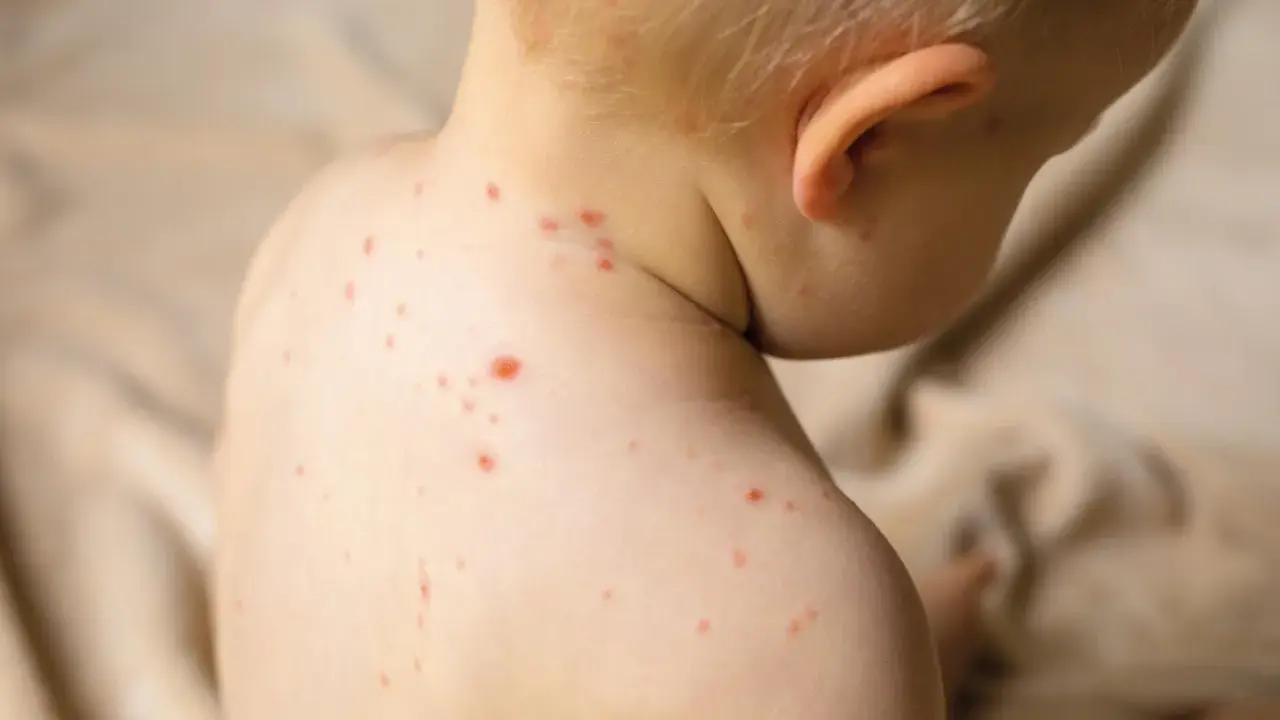 Enfant atteint de varicelle, avec des boutons rouges sur le dos et le cou. Conseils pour aider à comment faire sécher les boutons de varicelle rapidement.