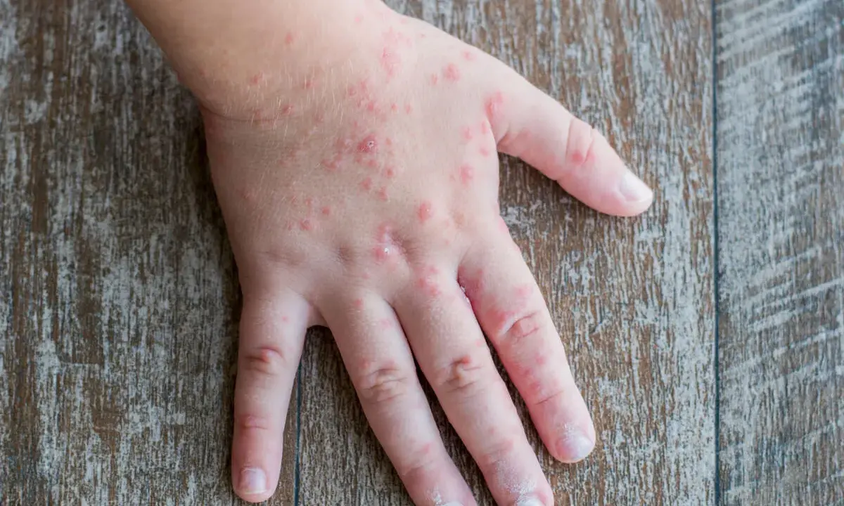 Mani di bambini con eruzioni cutanee rosse, simili a quelle che a volte compaiono su bocca e piedi.
