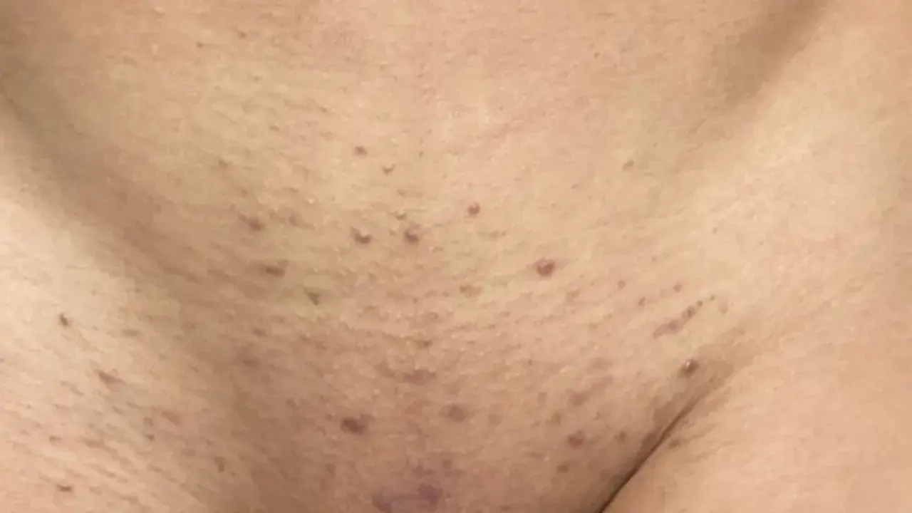 Peau présentant des boutons après rasage, avec des rougeurs et de petites imperfections.