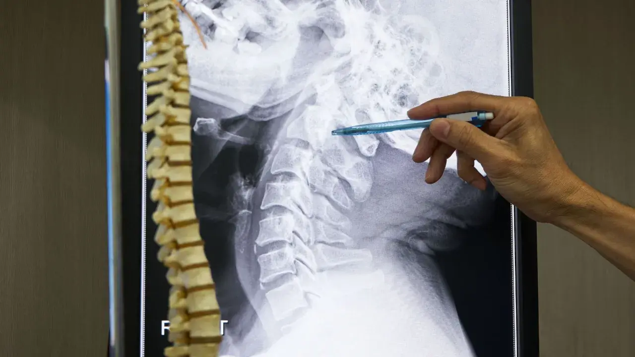 Un medico indica una radiografia della colonna vertebrale cervicale, evidenziando possibili metastasi ossee.