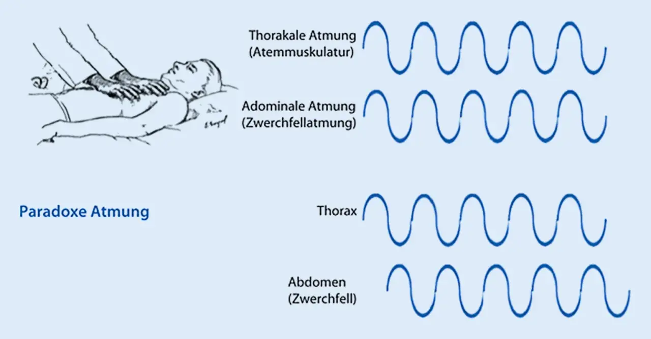 Illustration zeigt paradoxe Atmung. Die MRC Skala hilft, die Atmungsmuster zu verstehen: Thorakale vs. Abdominale Atmung und die paradoxe Bewegung von Thorax und Abdomen.