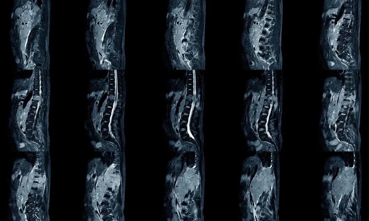 Obrazy MRI kręgosłupa ukazujące chorobę zwyrodnieniową. Widoczne zmiany mogą wpływać na stopień niepełnosprawności.