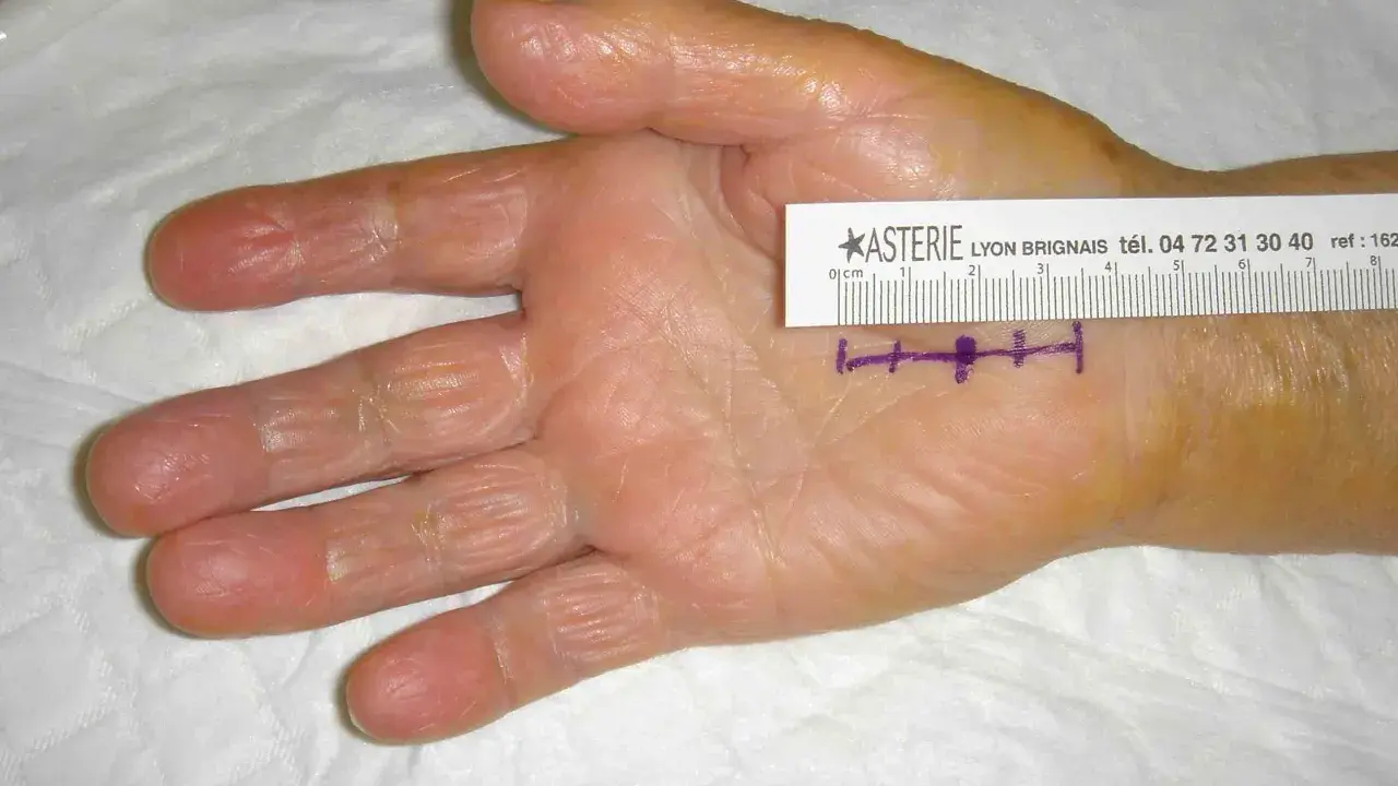 Main de patiente avec marques violettes et règle millimétrée, indiquant la zone d'intervention pour un syndrome du canal carpien.
