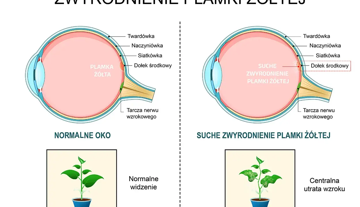 Porównanie zdrowego oka z plamką żółtą i oka z suchym zwyrodnieniem plamki żółtej, pokazujące utratę ostrości widzenia.
